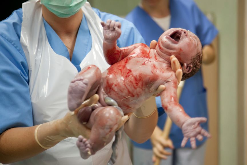 Baby wird beim Kaiserschnitt aus dem Bauch gehoben
