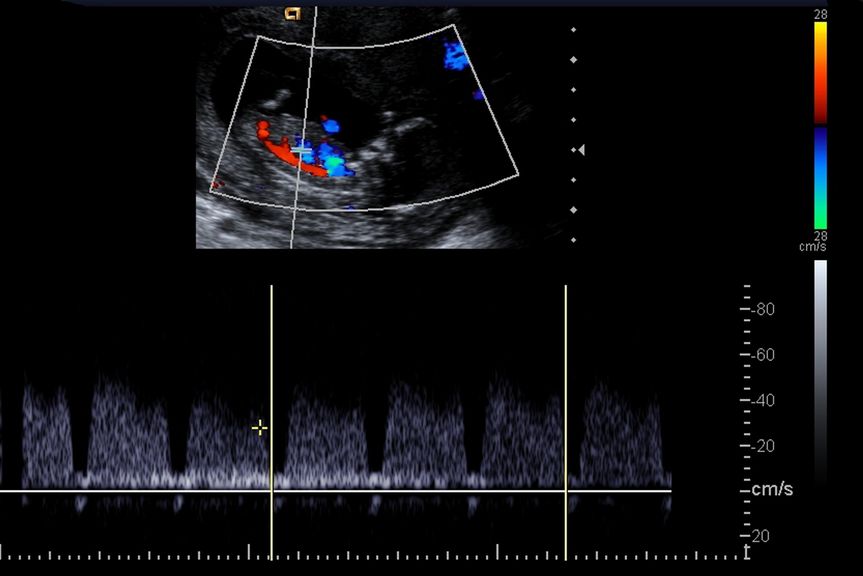 Sonographie; Durchblutung der Placenta