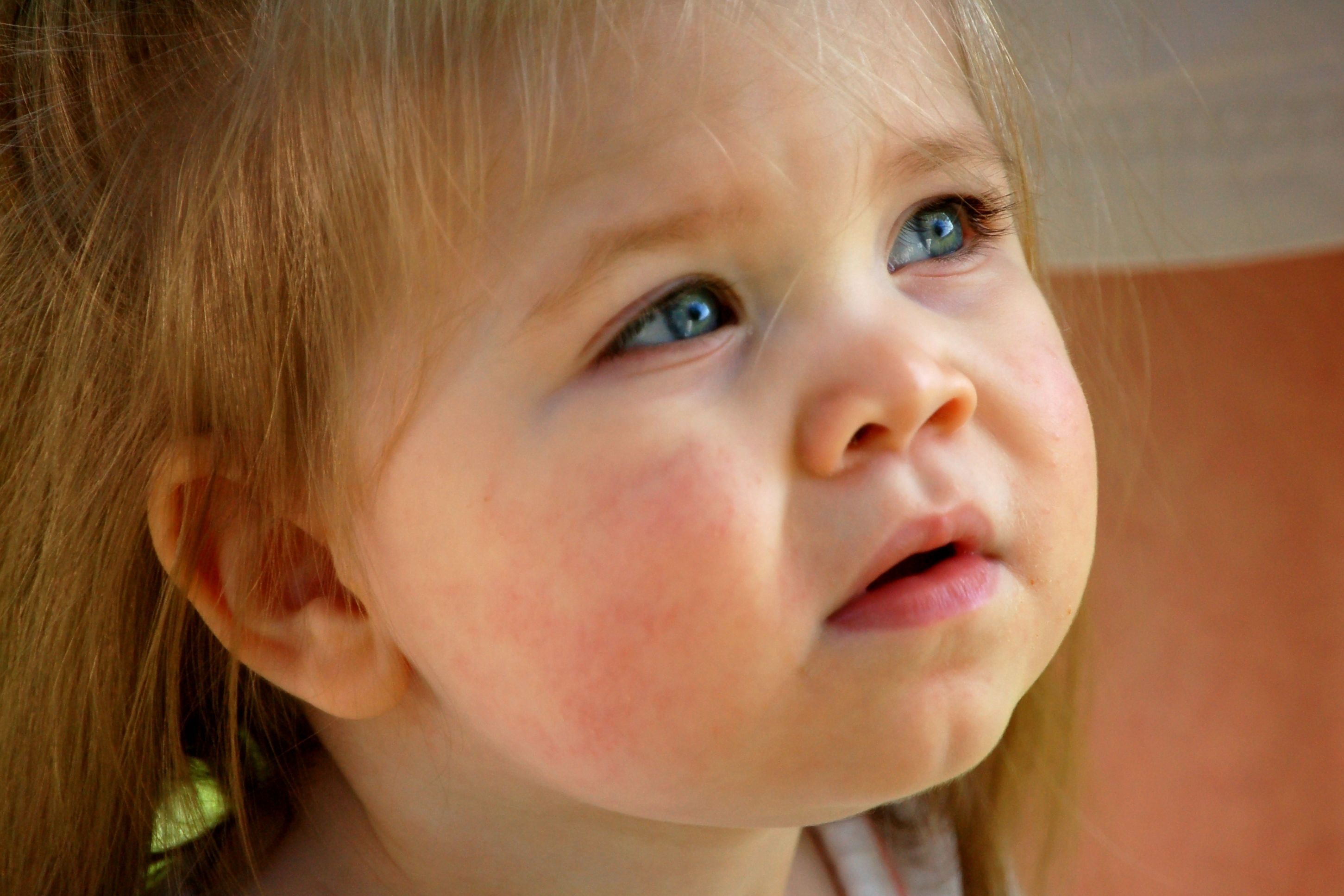Kind Ringelröteln B19 | beim | Parvovirus Kinderkrankheit