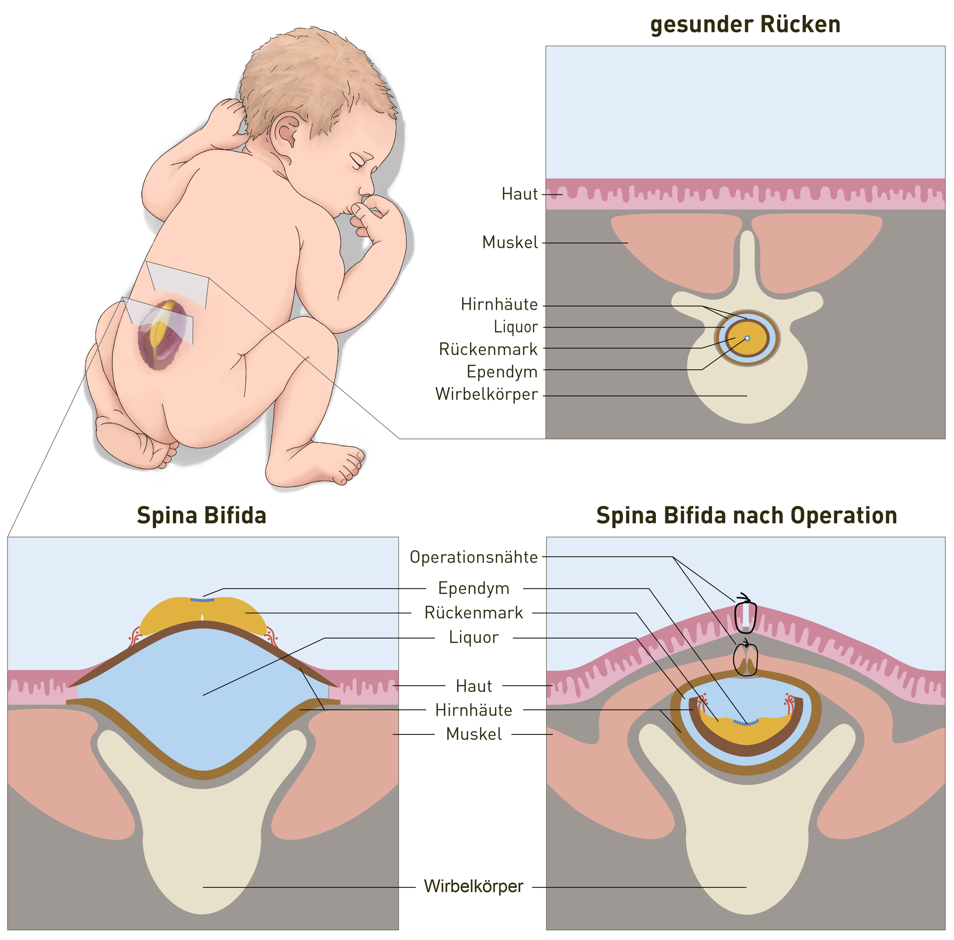 Illustration Spina Bifida Operation