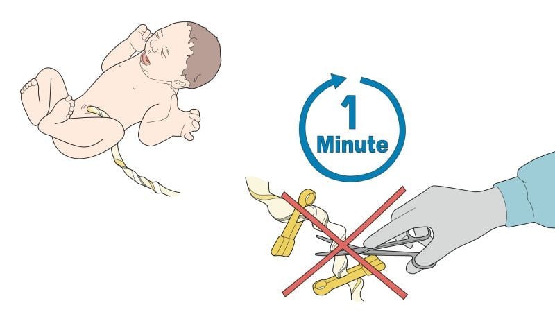 Grafische Darstellung zum späteren Durchtrennen der Nabelschnur bei Neugeborenen