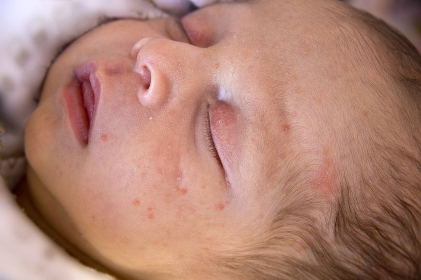 Hautveränderungen beim Neugeborenen