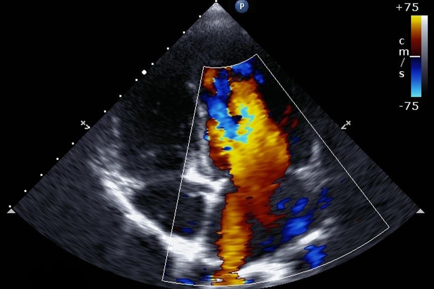 Doppler Echocardiographie