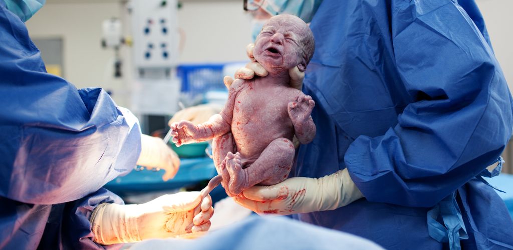 Baby direkt nach Kaiserschnitt; Nabelschnur noch nicht durchtrennt