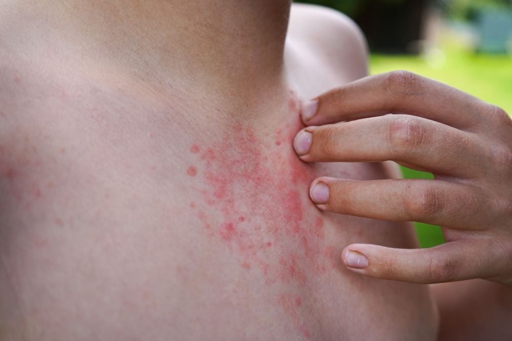 Allergie