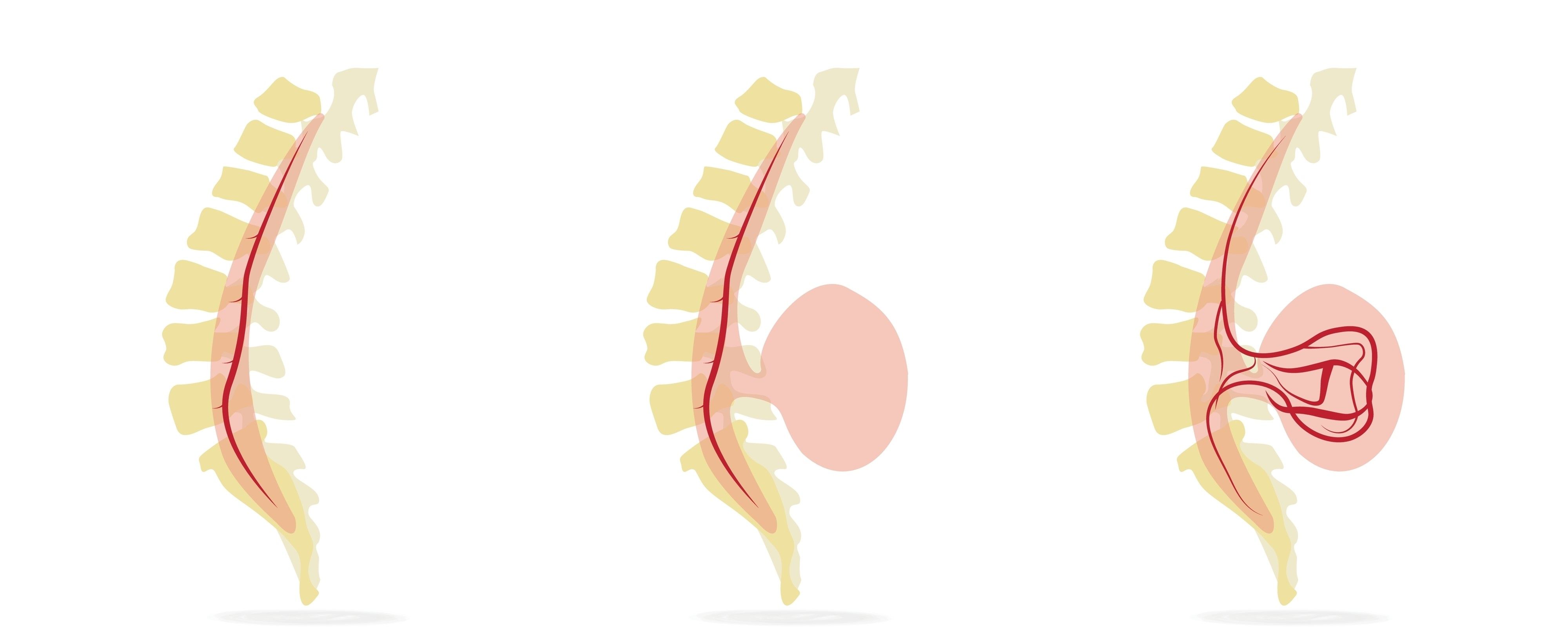 Spina bifida
