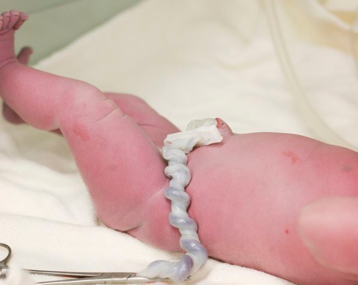 Neugeborenes mit Nabelschnur