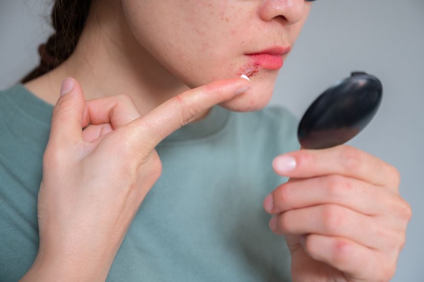 Frau mit einem Lippenherpes