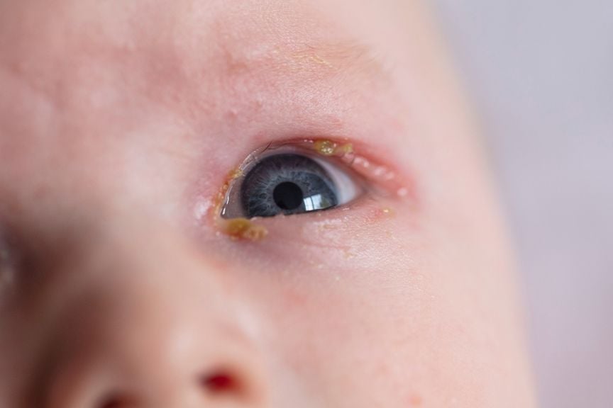 Verklebtes Babyauge