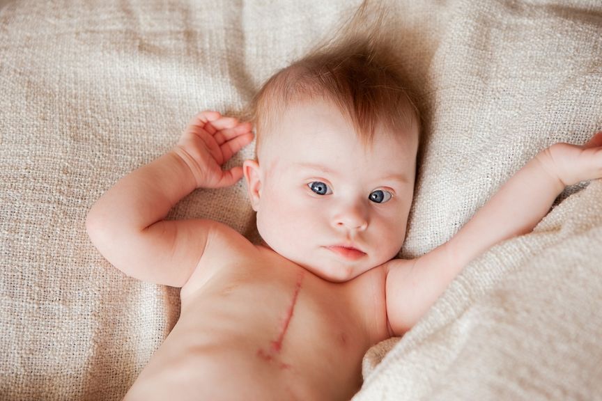 Baby mit Narbe