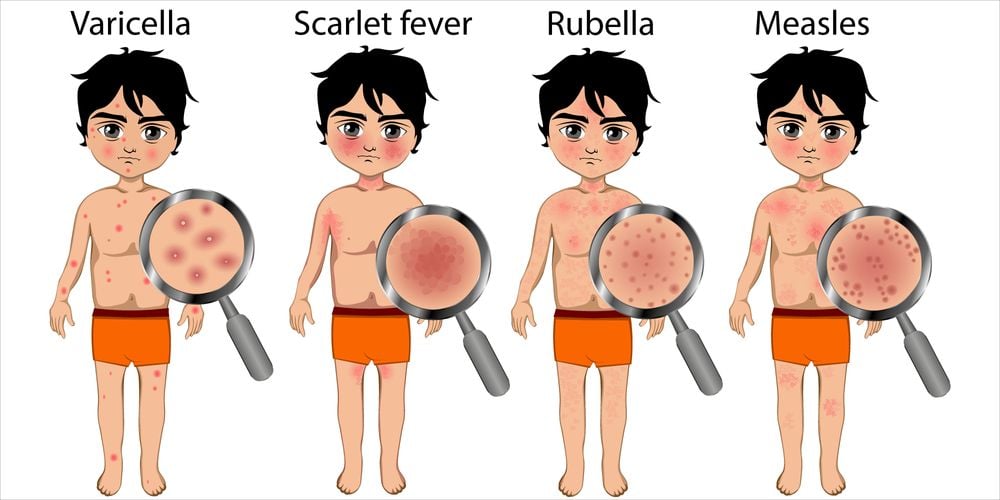 Varicella/Windpocken - Scarlet fever/Scharlach - Rubella/Röteln - Measles/Masern