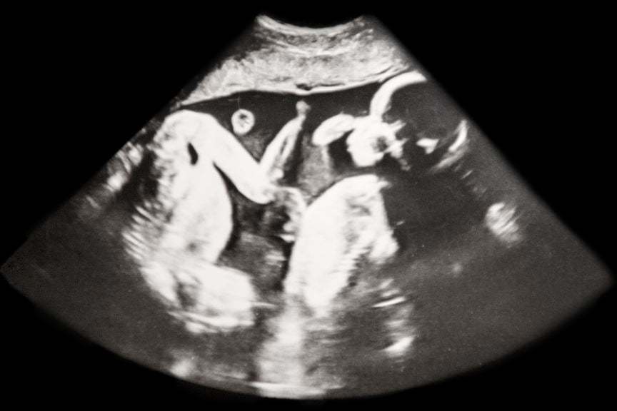Ultraschallbild von Zwillingen