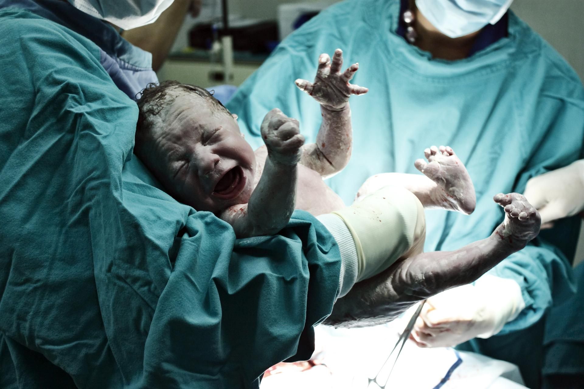 Neugeborenes nach dem Kaiserschnitt