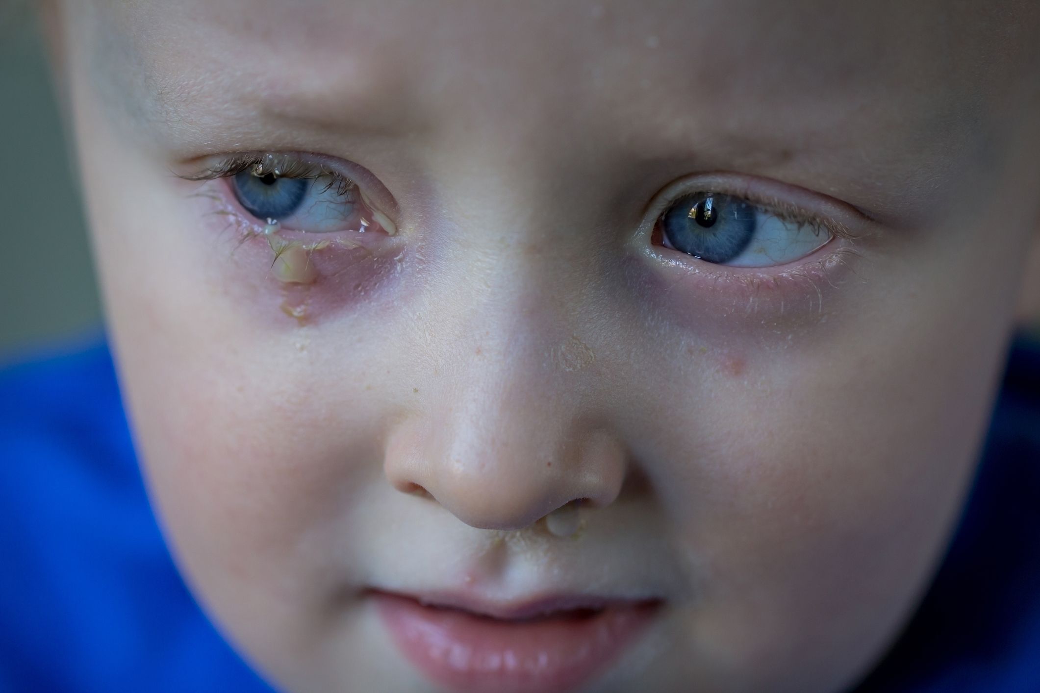 Was tun bei eitrigen Augen Kinder?