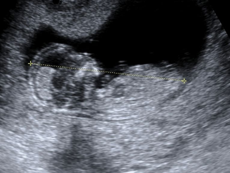 Ultraschall Baby