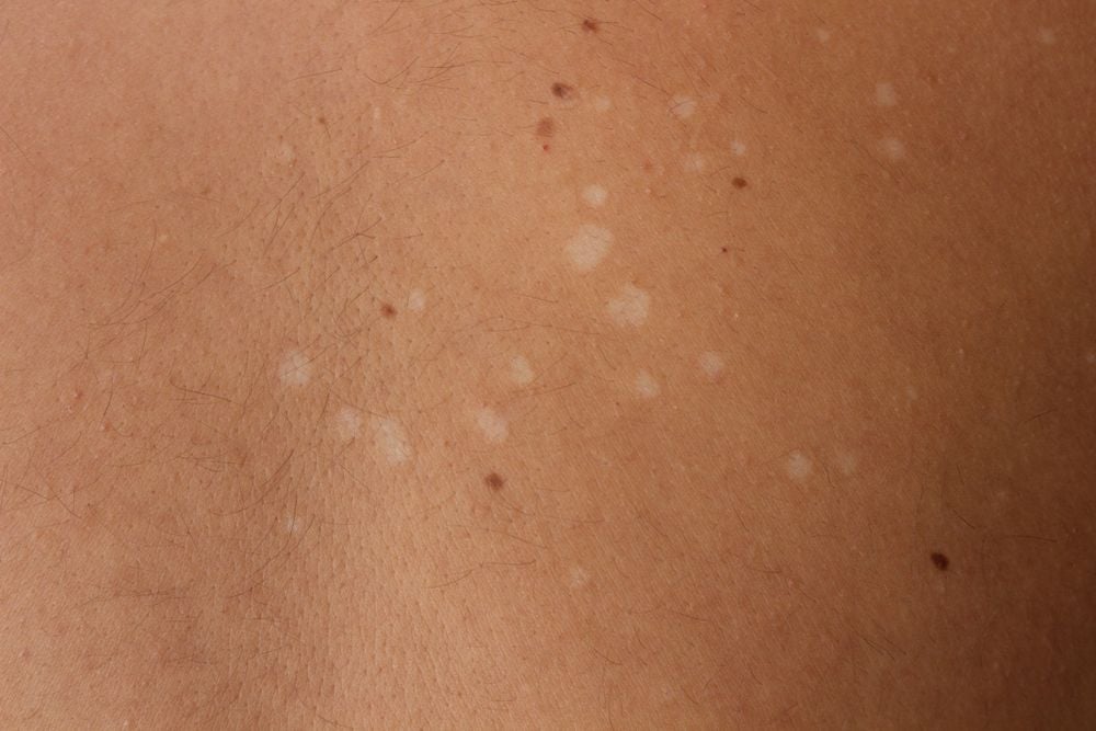 Pityriasis versicolor