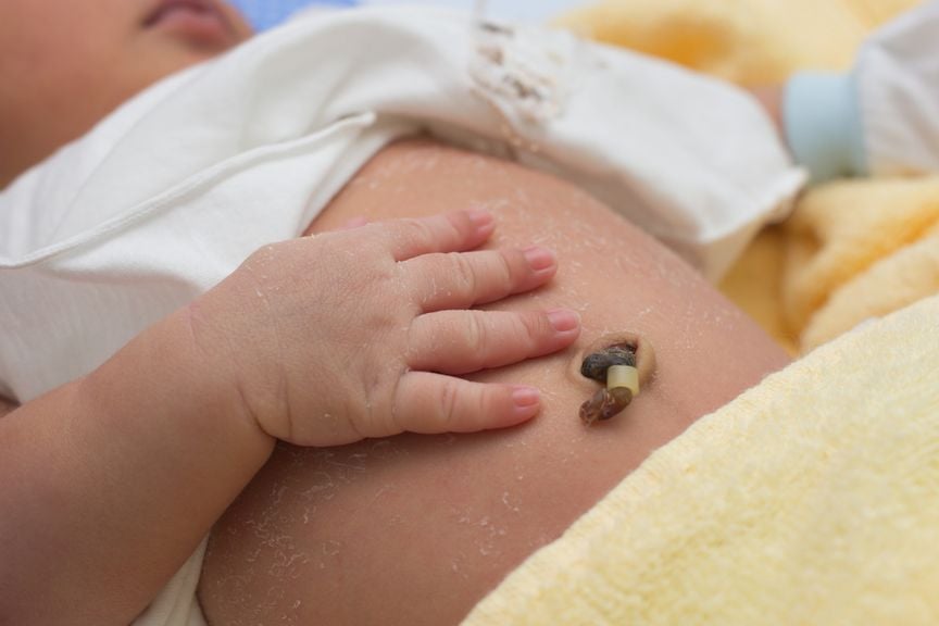 Neugeborenes mit Nabelschnurstumpf