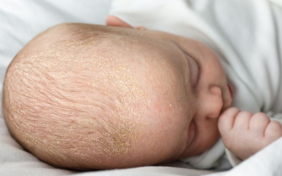 Säugling mit Milchschorf, Kopfgneis
