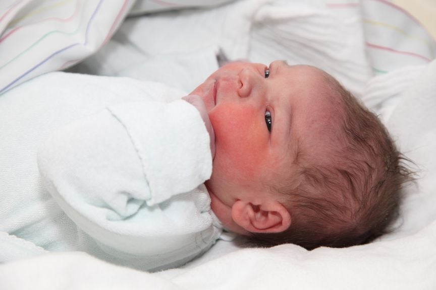 Neugeborenes nach der Geburt mit der Saugglocke