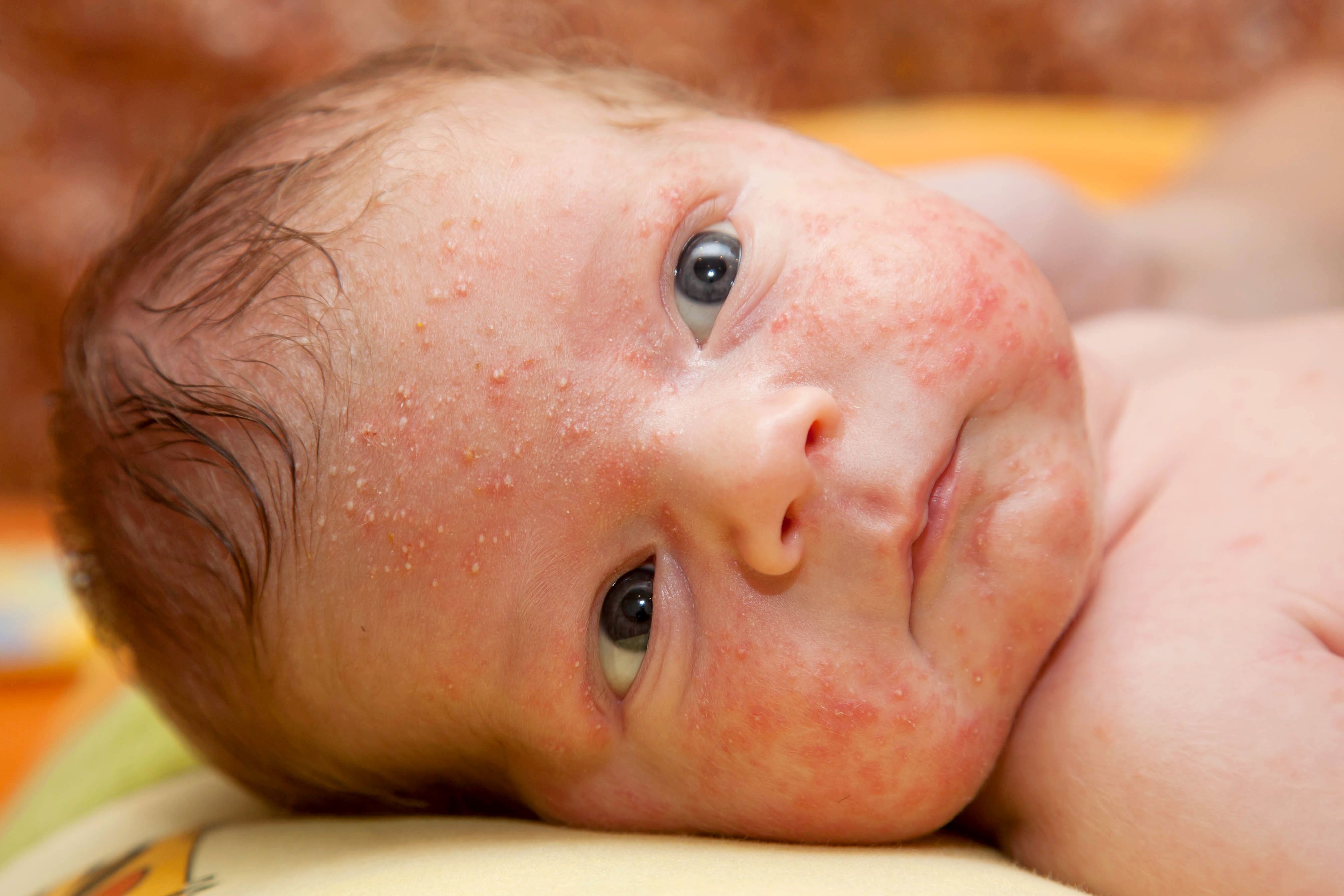 Baby mit Ausschlag im Gesicht