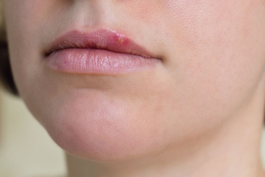Lippen einer Frau mit Herpesbläschen