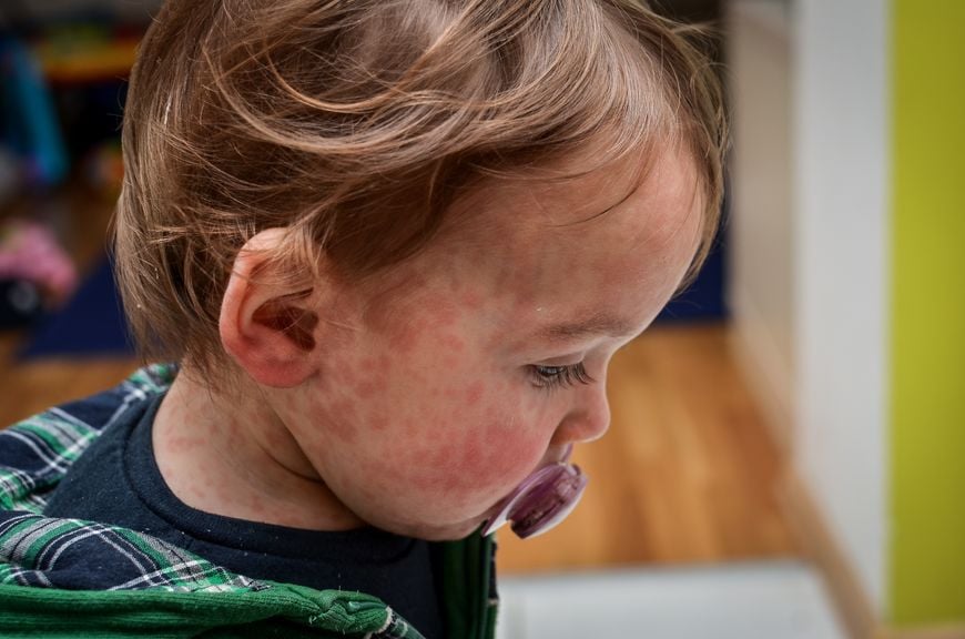 Kleinkind mit Masern-Ausschlag im Gesicht und am Hals
