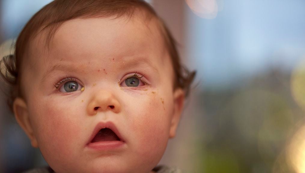 Baby mit verkrusteten Augen