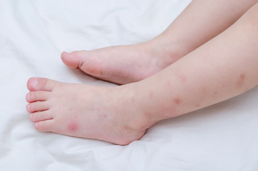 Mückenstiche an Kinderbeinen