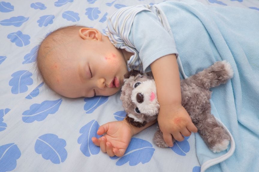 Schlafendes Baby mit Mückenstichen am Kopf und im Gesicht
