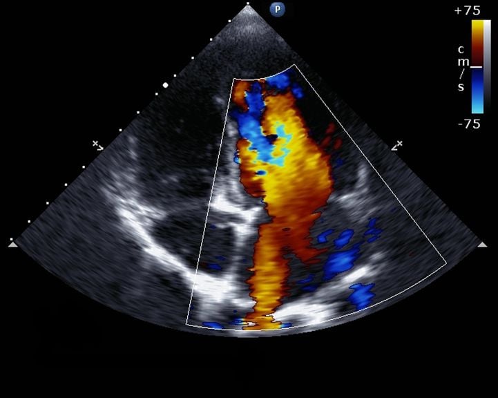 Doppler Echocardiographie