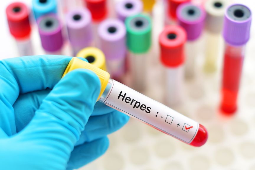 Herpes Test Reagenzglas positiv