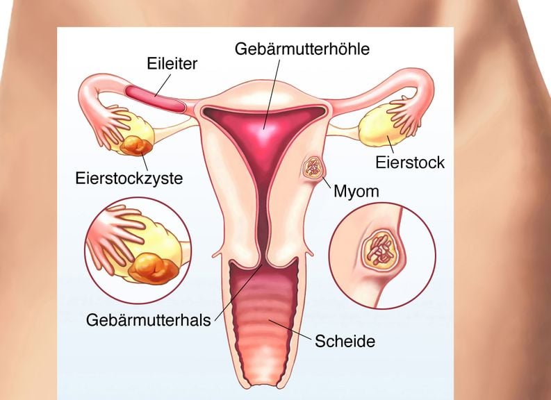 Gebärmutter mit Eierstockzyste und Myom, Bild über Becken der Frau