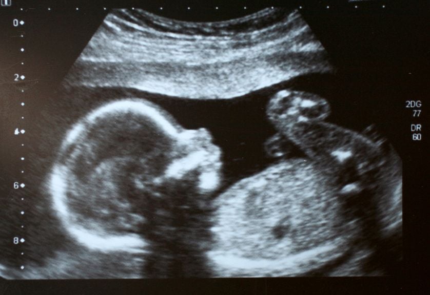 Ultraschallbild Baby